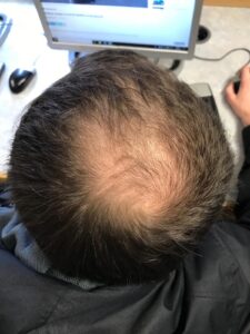 Say Goodbye to Hair Worries: Discover the Surprising Causes of Sudden Hair Loss